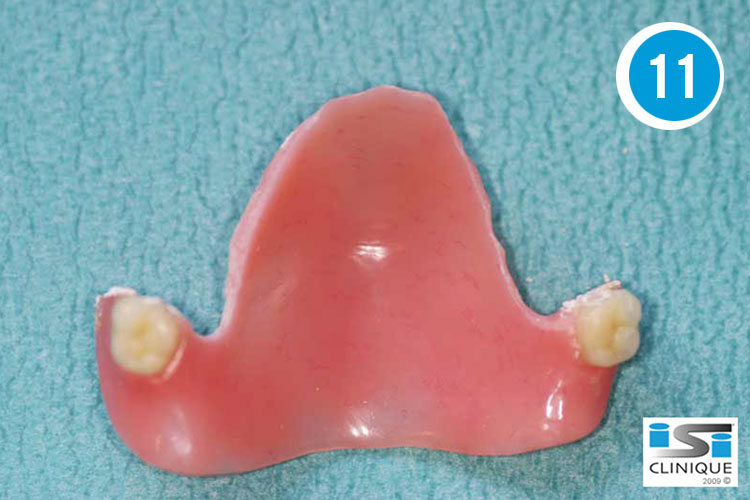 Implant dentaire 3D