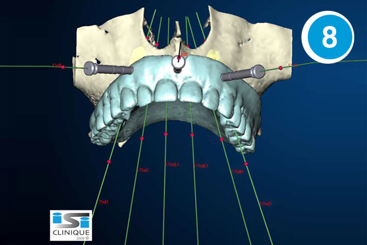 Implant dentaire 3D