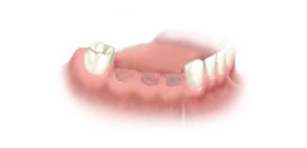 image-implant-une-dent