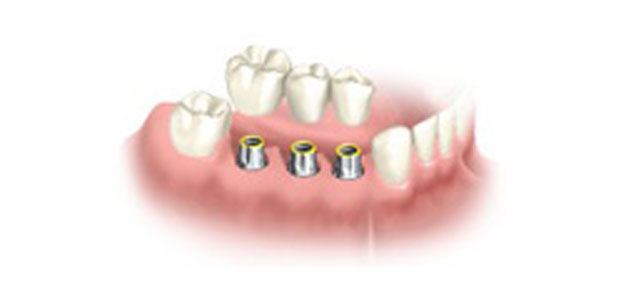 image-implant-une-dent