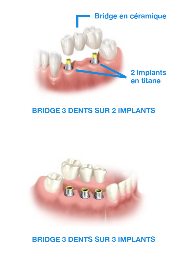 image-implant-une-dent