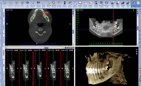 image-implant-une-dent