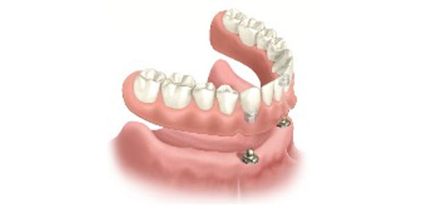 image-implant-une-dent